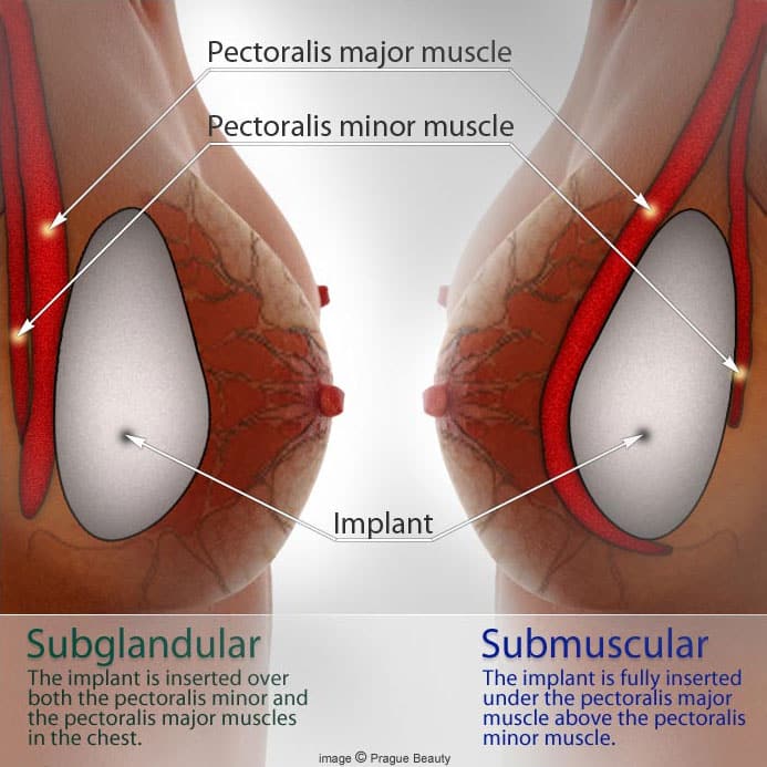 Woman breast implant cross section. Comparison diagram, under and over  pectoral muscle Stock Photo - Alamy