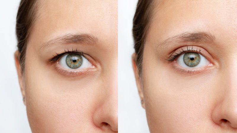 Cropped shot of a young caucasian woman's face with drooping upper eyelid before and after blepharoplasty isolated on a white background. Result of plastic surgery. Changing the shape, cut of the eyes.